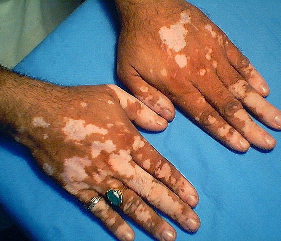 vitiligo