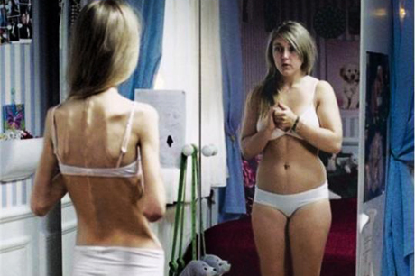 anorexia nervosa